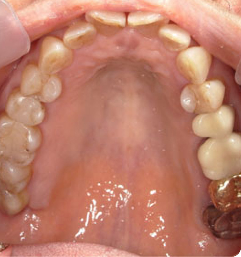 マウスピース矯正症例 術前