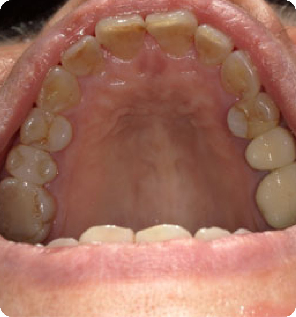 マウスピース矯正症例 術中