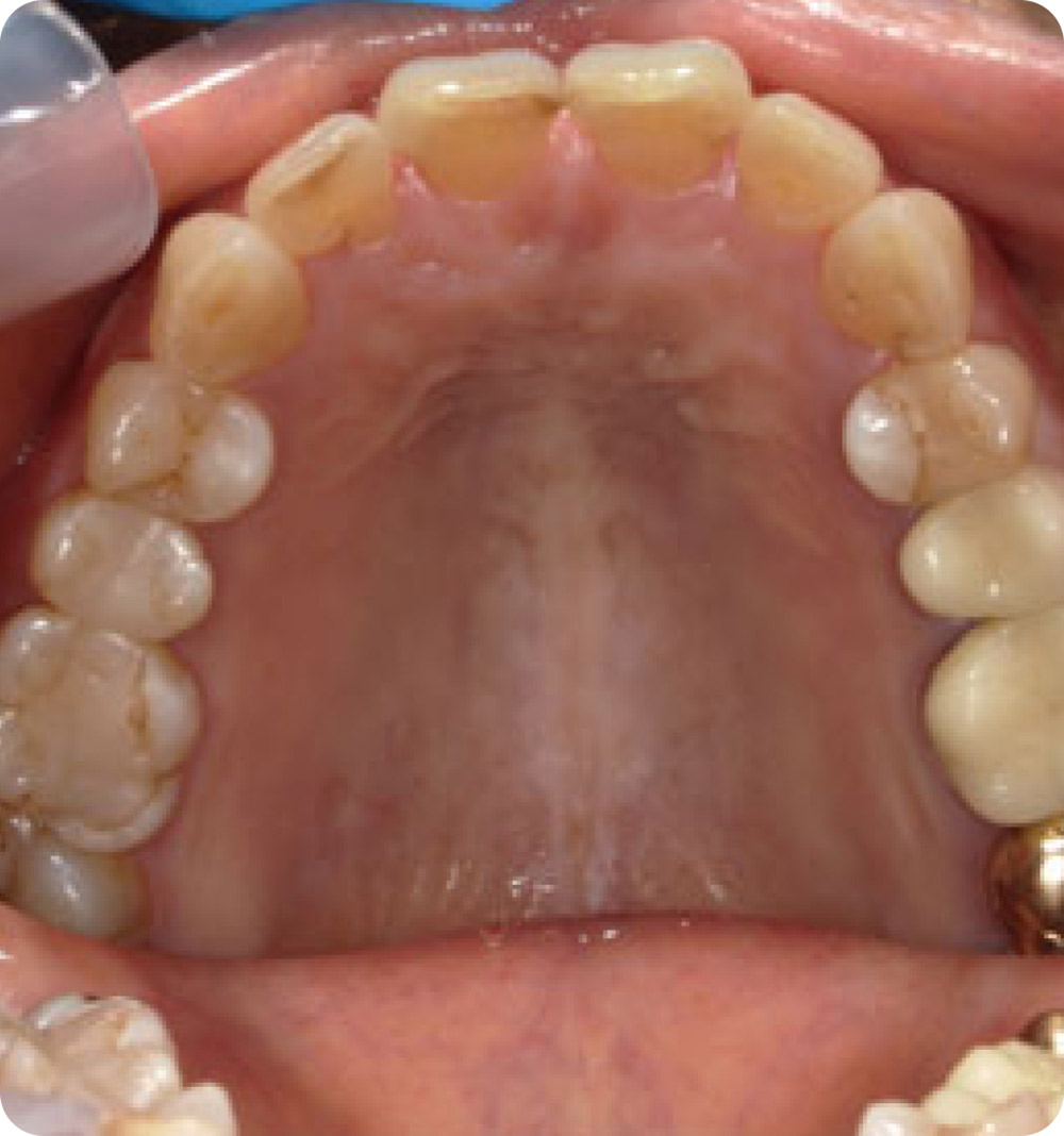 マウスピース矯正症例 術後